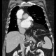 Hiatal hernia, upside-down stomach: CT - Computed tomography